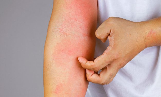 Día Mundial de la Dermatitis Atópica: lo que no se ve de la picazón