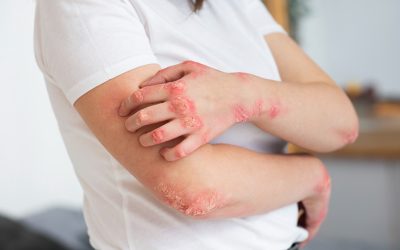 Comenzó la campaña de detección gratuita de dermatitis atópica