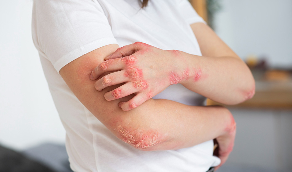 dermatitis,