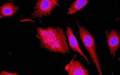 Investigadores del CONICET lograron avances en el tratamiento del glioblastoma