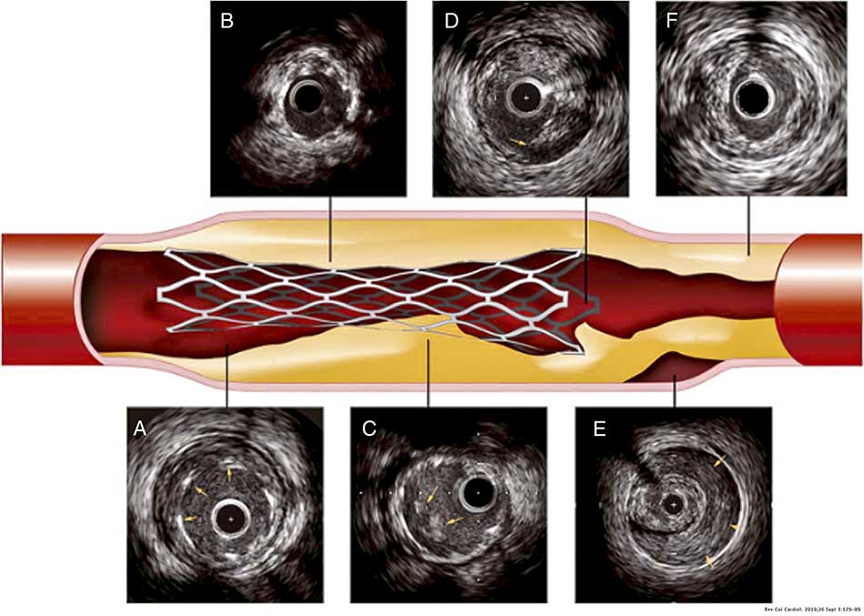IVUS Intravascular Ultrasound Textbook of Interventional Cardiology