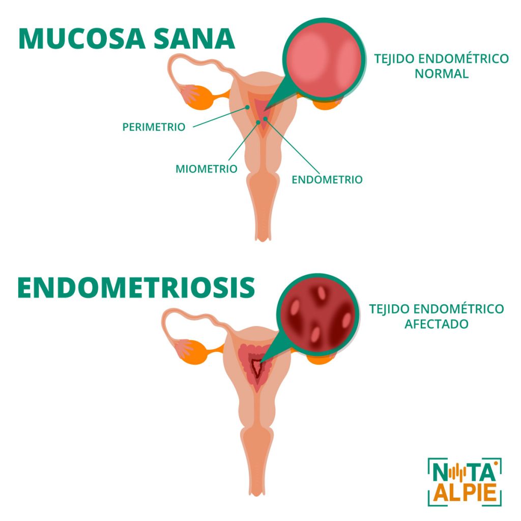 Endometriosis: jornada de acción y concientización para una detección temprana 2 ENDOMETRIOSIS noelia acuna