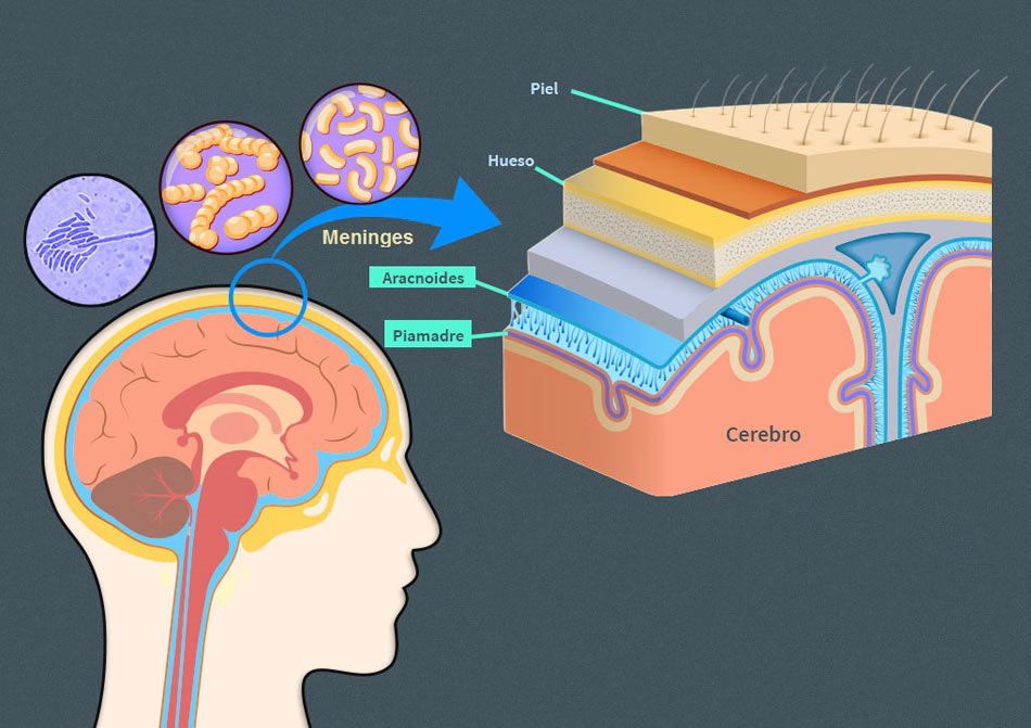 Meningitis