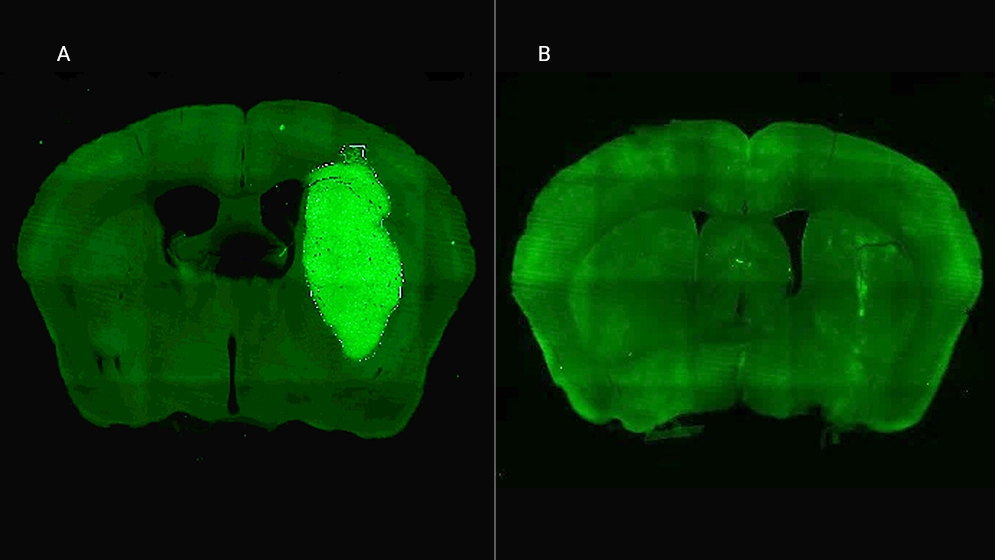 Glioblastoma