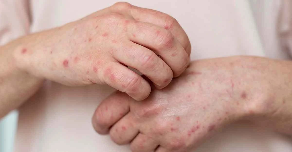 La OPS pide “compromiso político y cooperación” tras el regreso del sarampión 1 sarampion