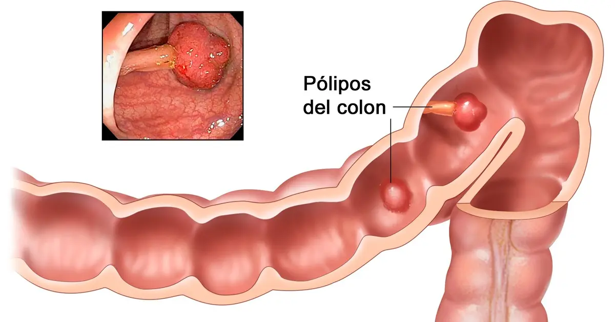 Cáncer de colon: la prevención sigue en agenda ante el aumento de casos en Argentina 2 cáncer