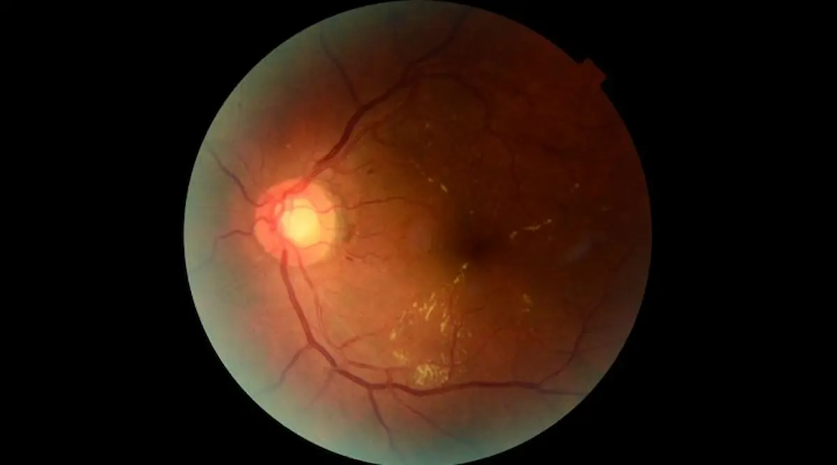 Retinar, la plataforma argentina que usa inteligencia artificial para detectar a tiempo la retinopatía diabética 1 retinar