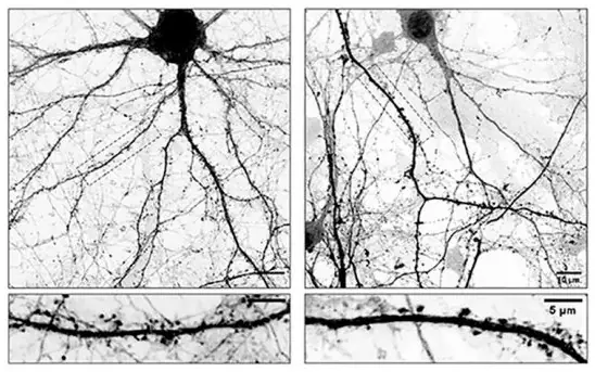 Un hallazgo argentino reabre el debate sobre las terapias para el Parkinson 2 Parkinson